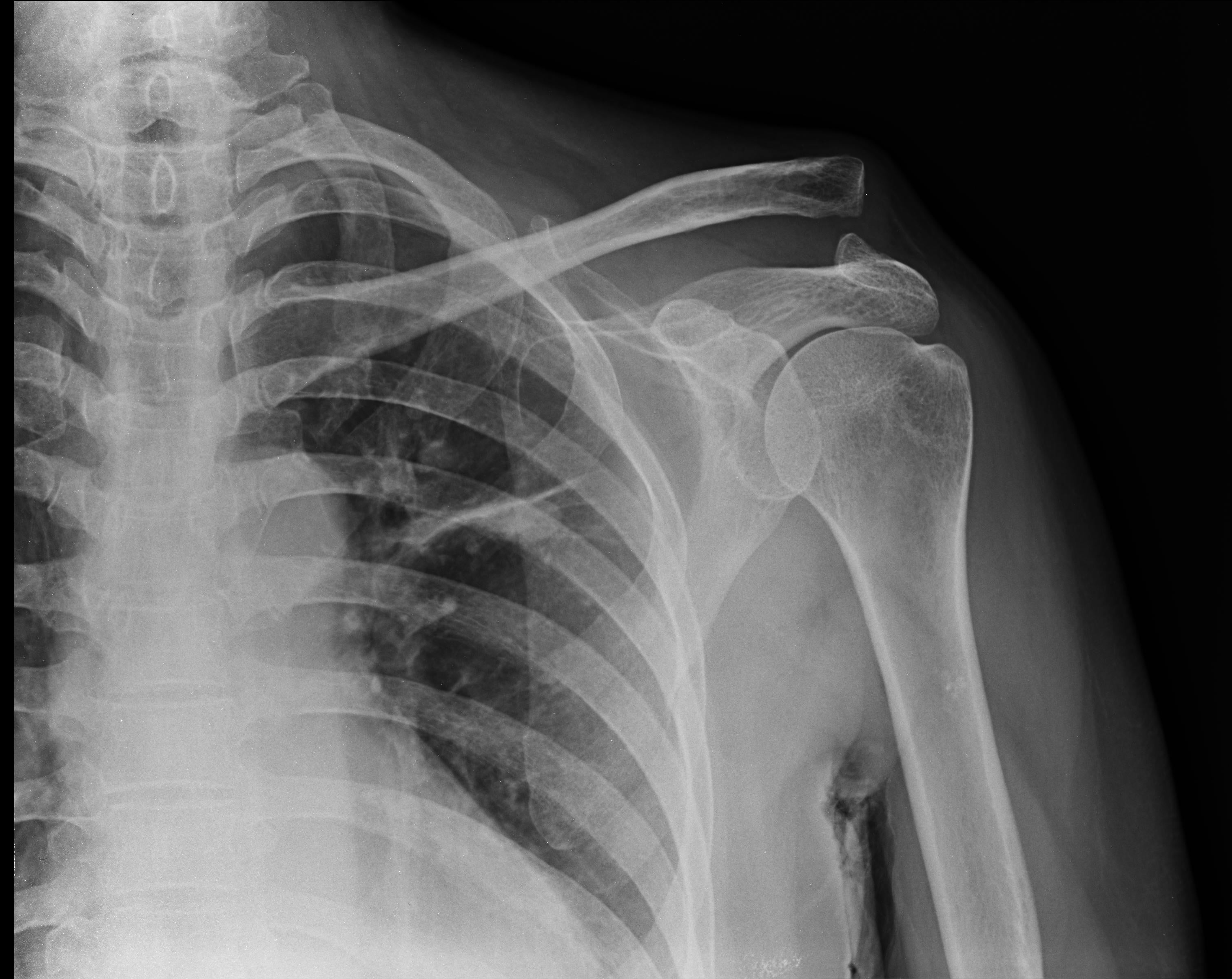 Radiografia spalla e torace, 3020x2400 2K, Desktop