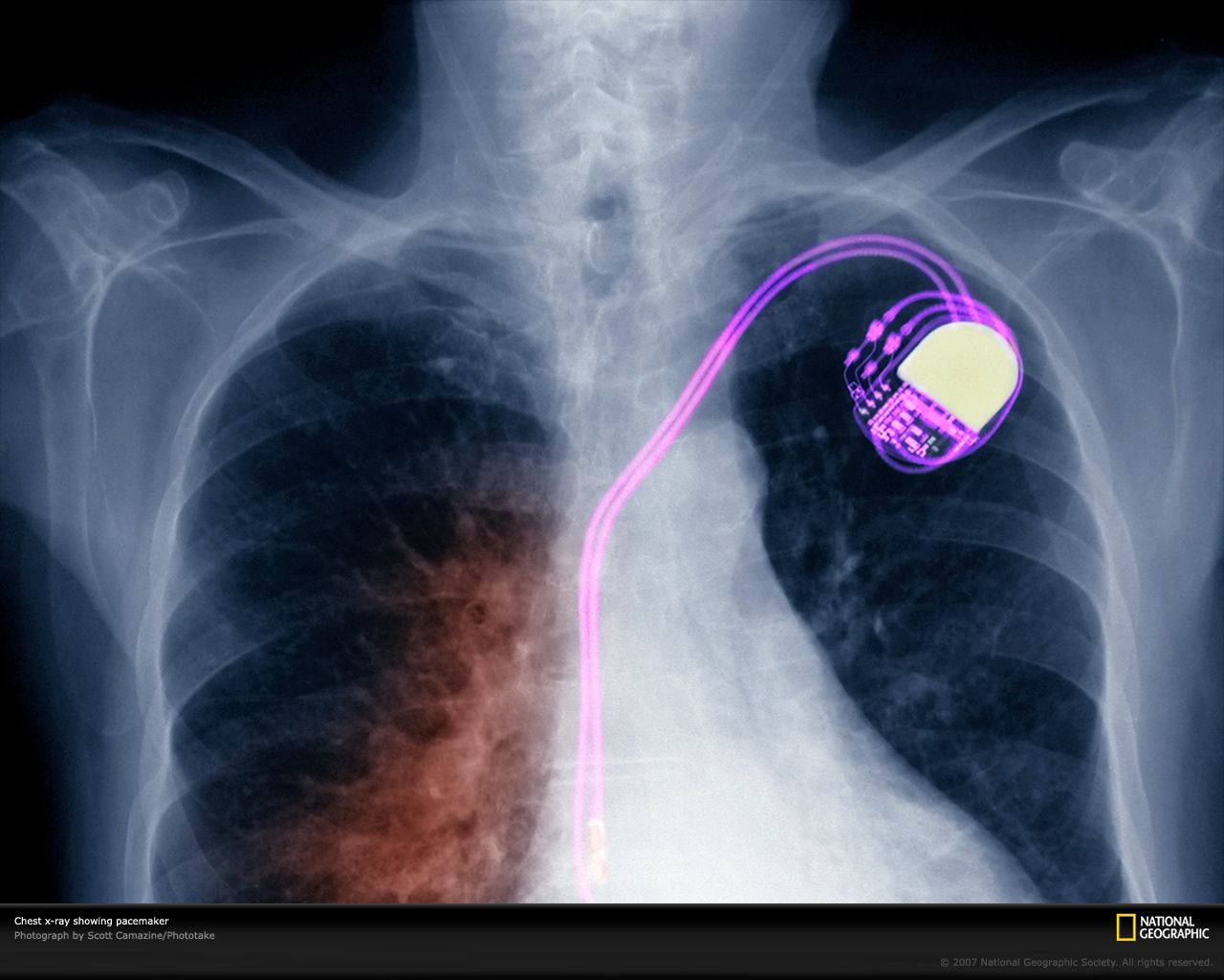 Radiografia torace con pacemaker, 1280x1024 720p, Acer Nitro