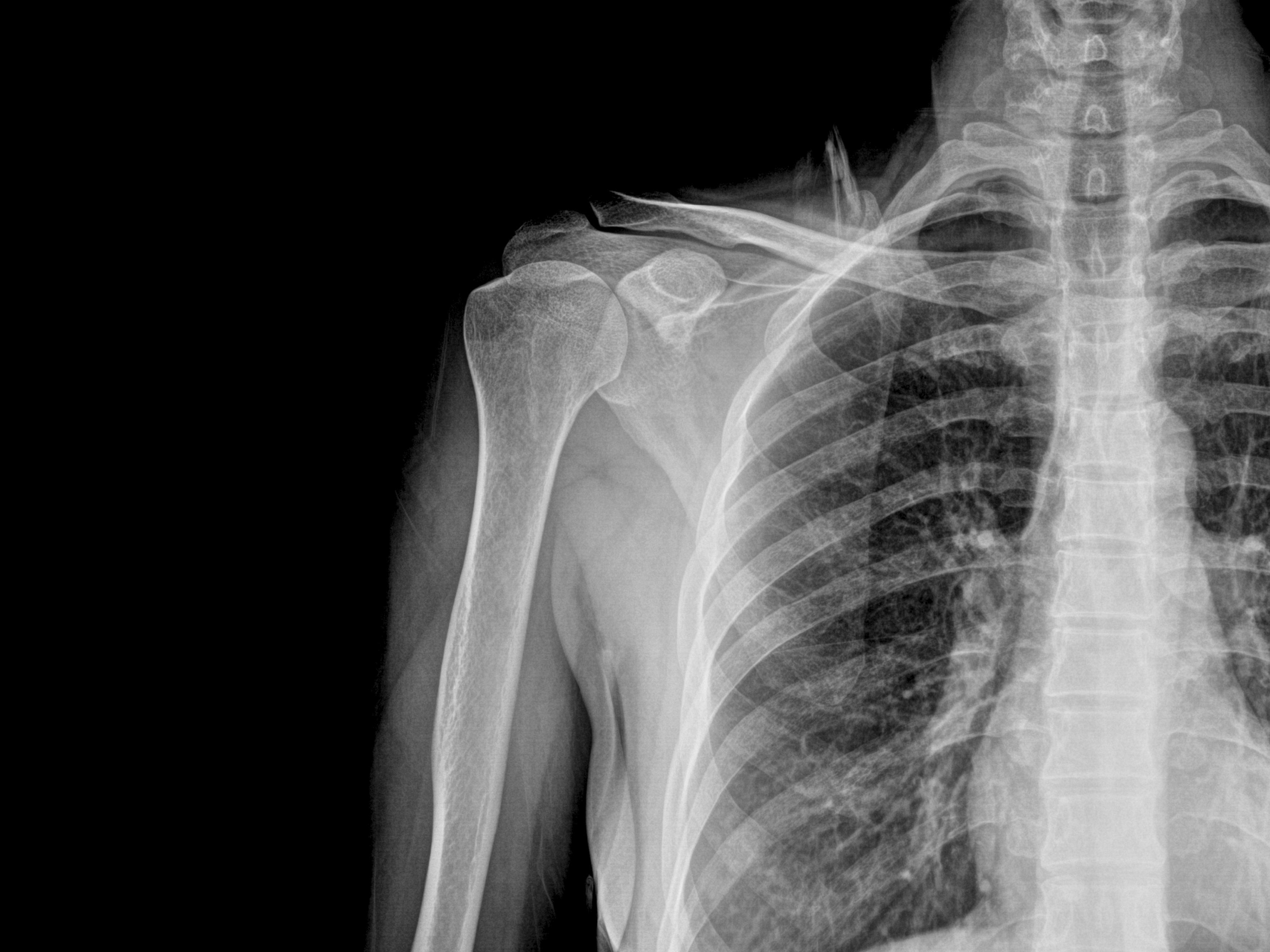 Radiografia spalla e torace, 3500x2625 2K+, PC
