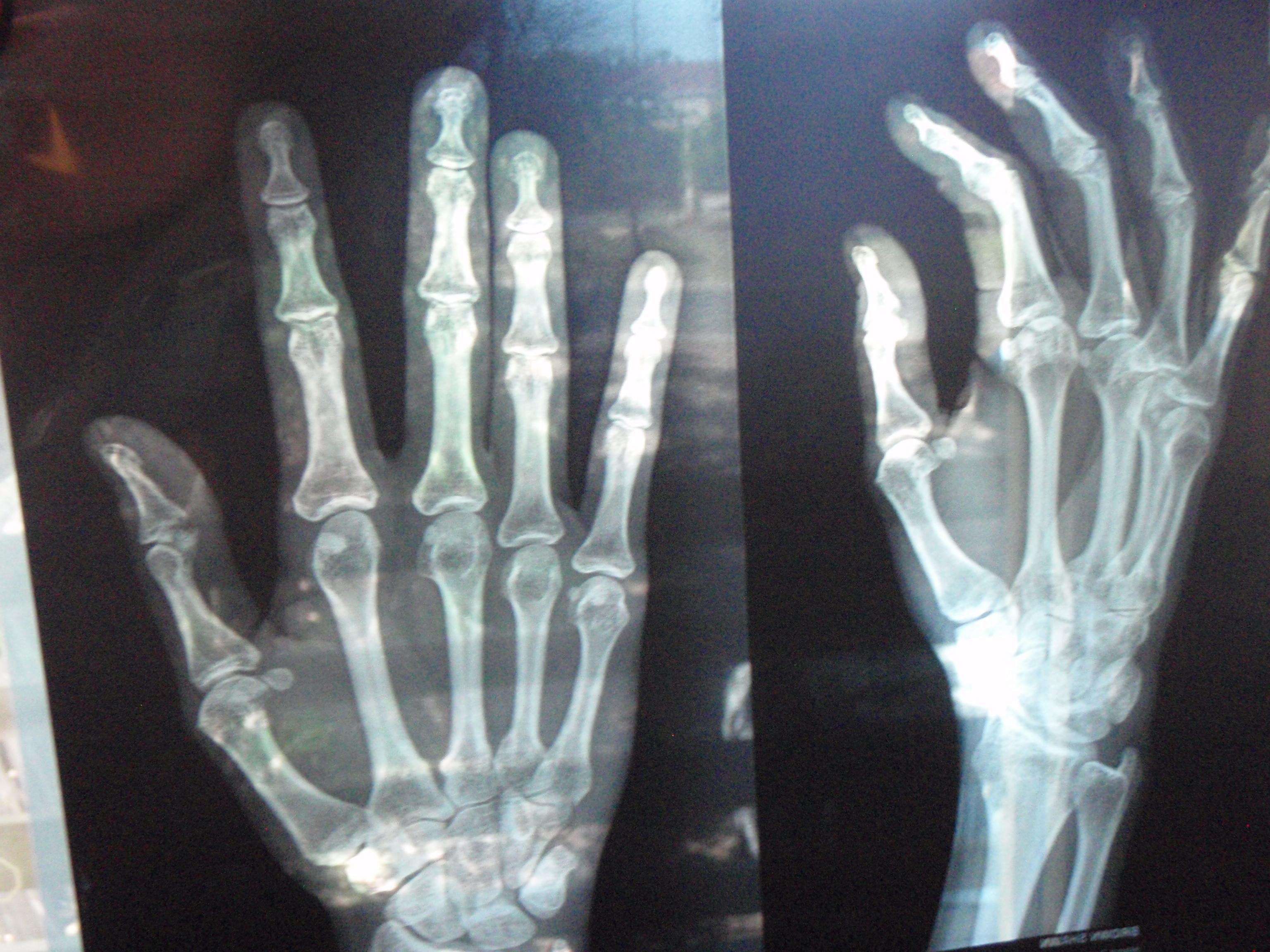 Radiografia mano su schermo, 1000x1250 Full HD Verticale, Realme