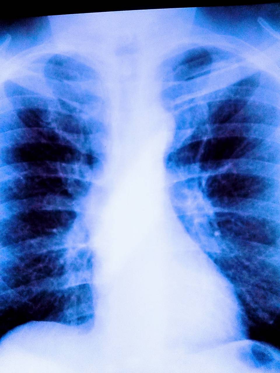 Radiografia torace polmoni blu, 960x1280 Verticale, Telefono