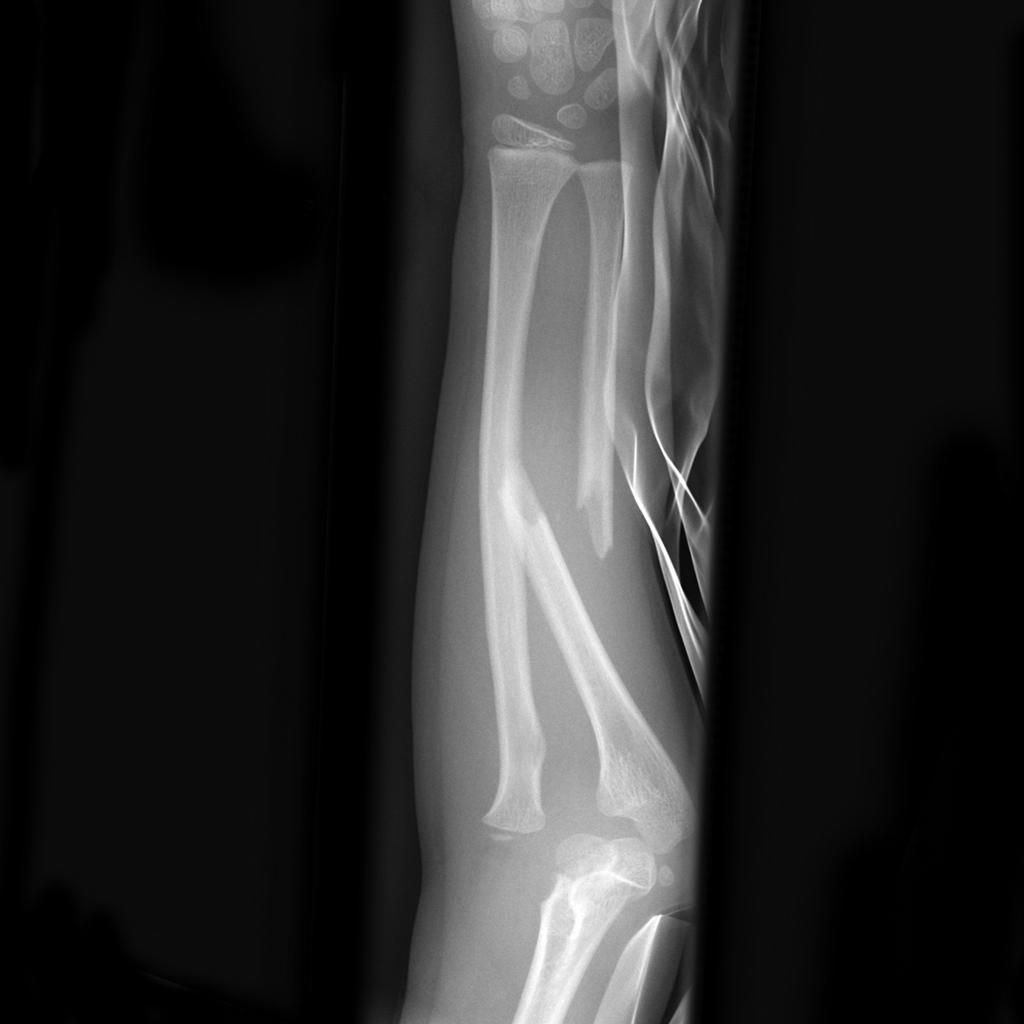 Radiografia frattura avambraccio, 1024x1024 HD, iMac