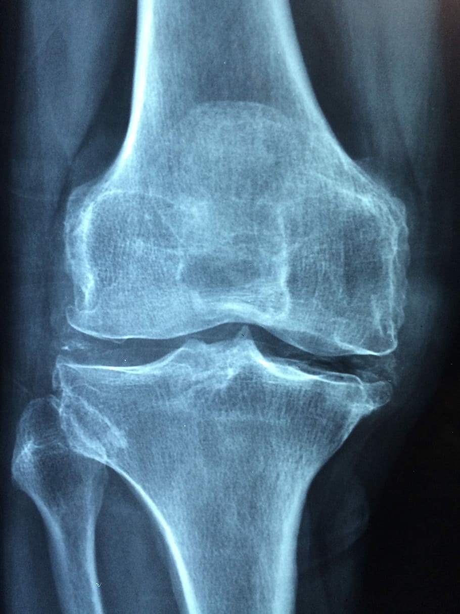 Radiografia ginocchio osso blu, 910x1213 Full HD Verticale, Smartphone