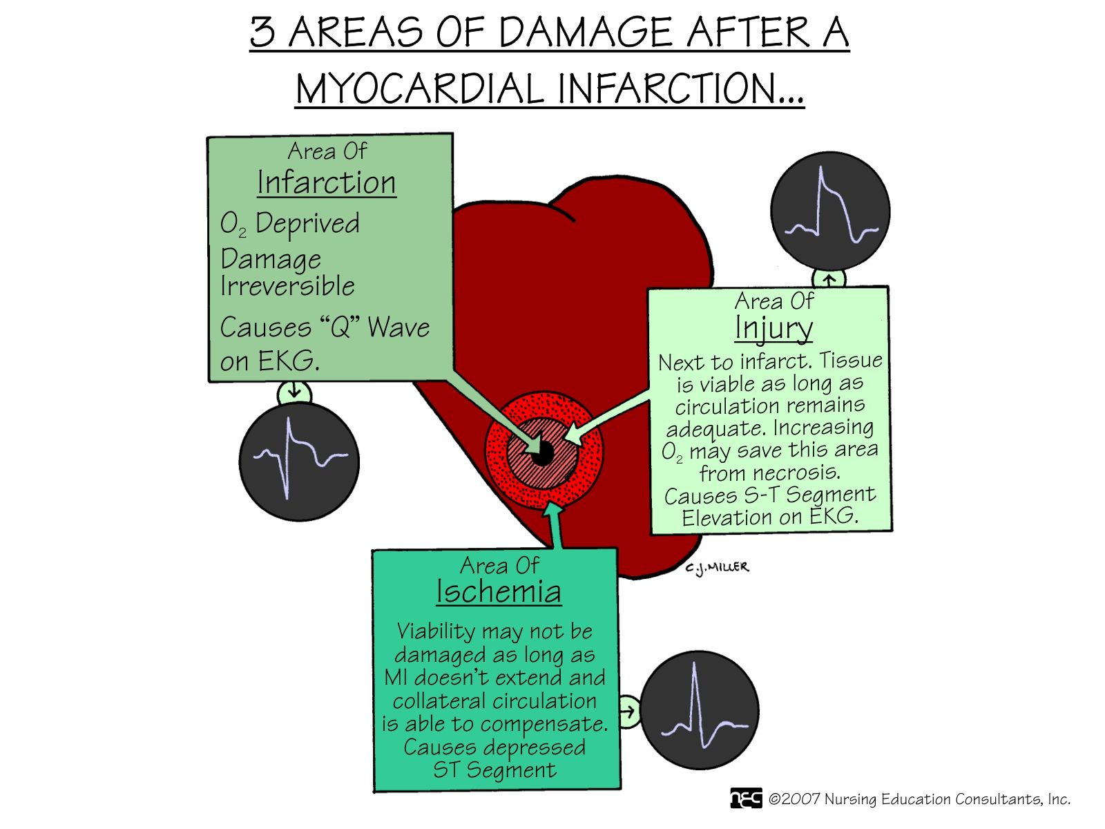 Infografica infarto miocardico cuore, 1600x1200 HD Ready, PC